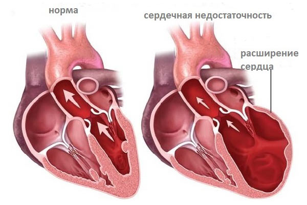 Симптомы и лечение диффузного кардиосклероза